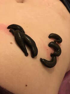 Мой вес 85.100 ( пошла на пиявочки)