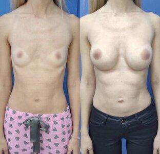 До и после. Пластика груди. Пластический хирург - Карапетян Георгий Эдуардович