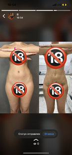 Видео-дневник липосакции, реабилитации и восстановления после 