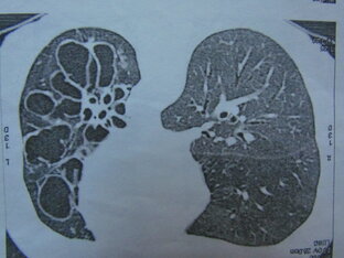 Все темы только об исцелении ХОБЛ.