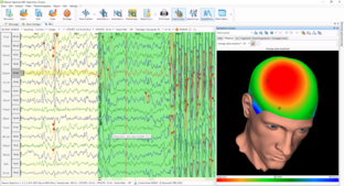 ЭЭГ при эпилепсии