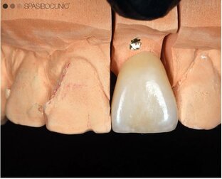 ПРОТЕЗИРОВАНИЕ