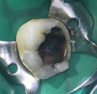 Кариес и его осложнения.