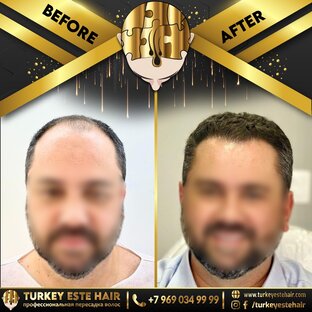 пересадка волос в москве по шокирующим ценам 