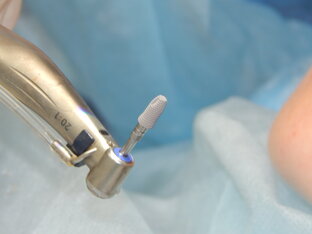 Имплантация