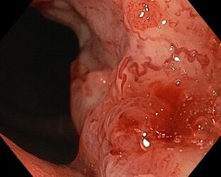 Видео- ЭГДС