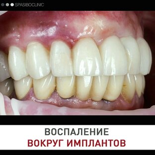 ПЕРИИМПЛАНТИТ