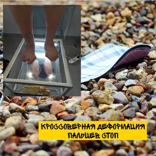 Кроссоверная деформация пальцев стоп 