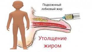 Липофилинг полового члена 