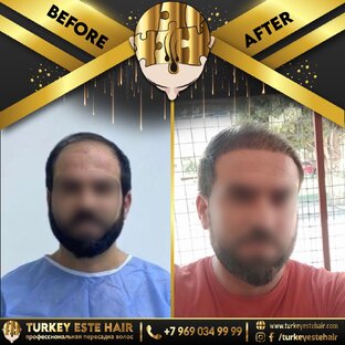 Пересадка волос