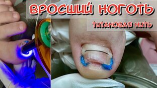 Вросший ноготь / Титановая нить