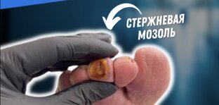 СТЕРЖНЕВАЯ МОЗОЛЬ