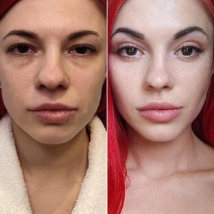 До и после. Блефаропластика. Пластический хирург - Карапетян Георгий Эдуардович