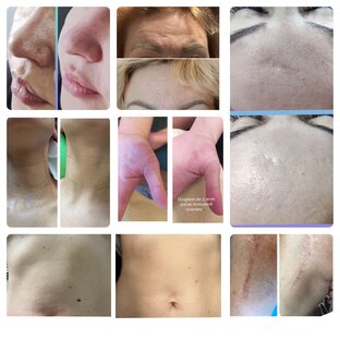 Процедура Холодная плазма