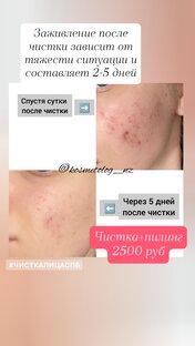 Чистка лица 