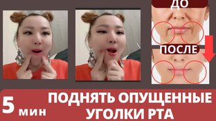 Опущенные Уголки Рта