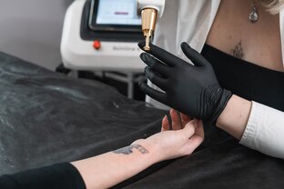 Лазерное удаление татуировки 