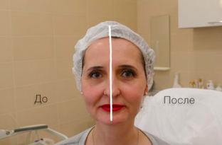Инъекционная косметология