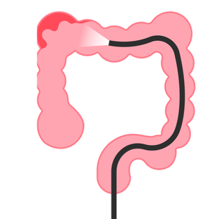 Колоноскопия