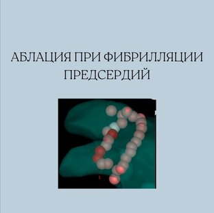 Самое важное о фибрилляции предсердий 