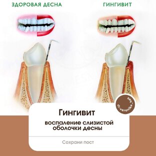 Гингивит 