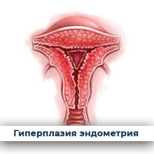 Гиперплазия эндометрия