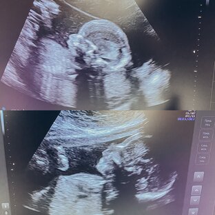 Беременность двойней