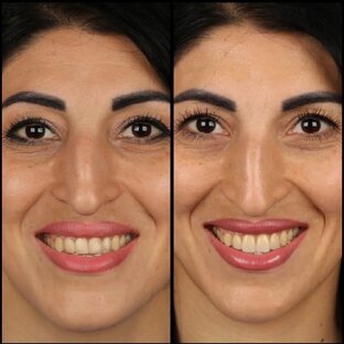 Протезирование зубов