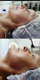 Лифтинг лица