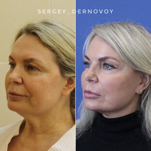 Пластика лица