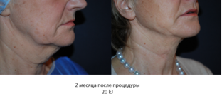 Омоложение лица