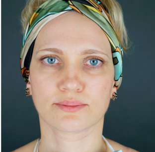 Круговая подтяжка