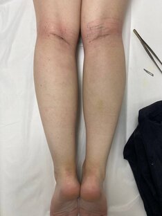 Круропластика (пластика голени)