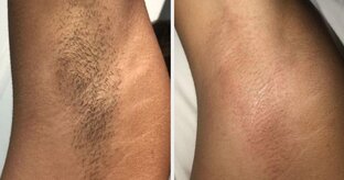 Элос-эпиляция.