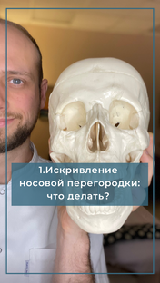 Искривление носовой перегородки