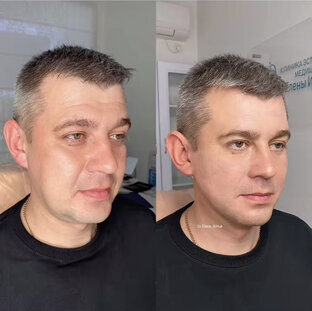 Full Face - комплексное омоложение лица