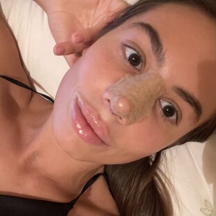 Ринопластика 2023