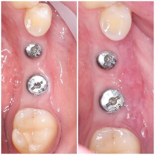 Десневая пластика