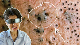 Залежи на возрастной коже