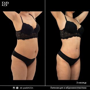 Липосакция живота | +7 925 767 40 14