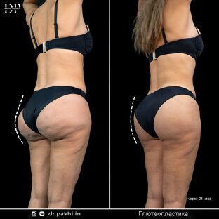 Глютеопластика | +7 925 767 40 14