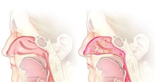 РИНИТ (НАСМОРК). ЛЕЧЕНИЕ НАРОДНЫМИ СРЕДСТВАМИ