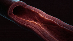 СОСУДЫ И АТЕРОСКЛЕРОЗ