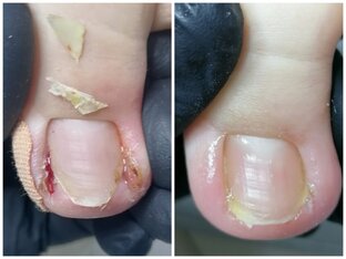 Вросший ноготь 