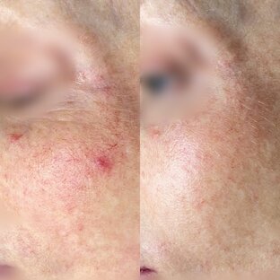 Cосуды на лице