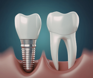 Протезирование