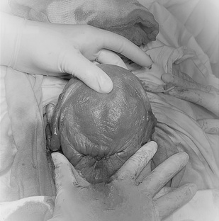 Роды с рубцом