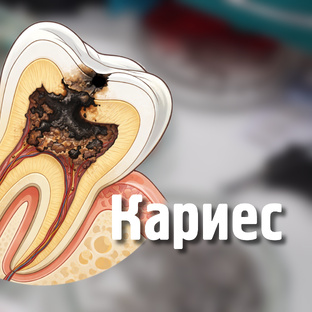 Кариес