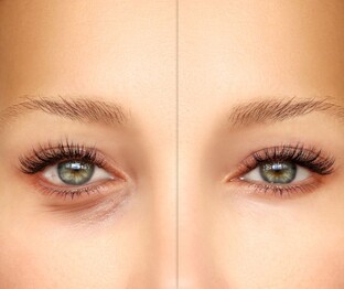 Блефаропластика