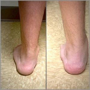 Здоровые стопы